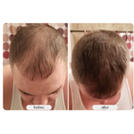 1+1 GRATIS | The HairGrower ™